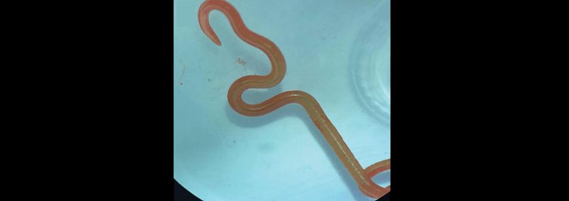 roundworm removed from woman's brain